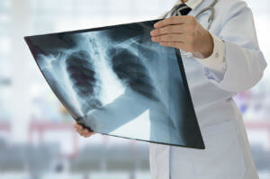 doctor holding x-ray of lungs