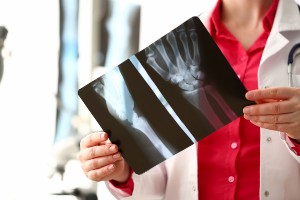 qualifying for disability benefits for a bone fracture